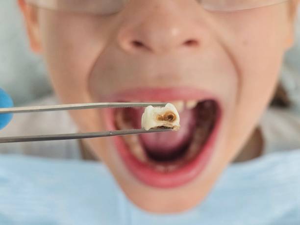 Best Emergency Dental Care for Abscessed Tooth in Scottsboro, AL